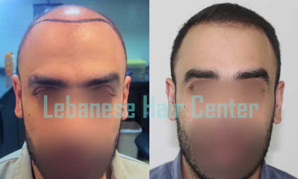 Hair loss Lebanon