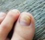 210707 The Foot Practice Prevent Toenail Fugus.jpg 90x80
