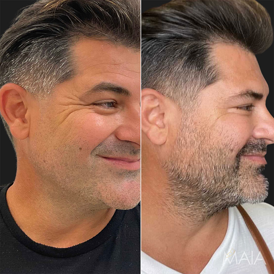 botox before and after