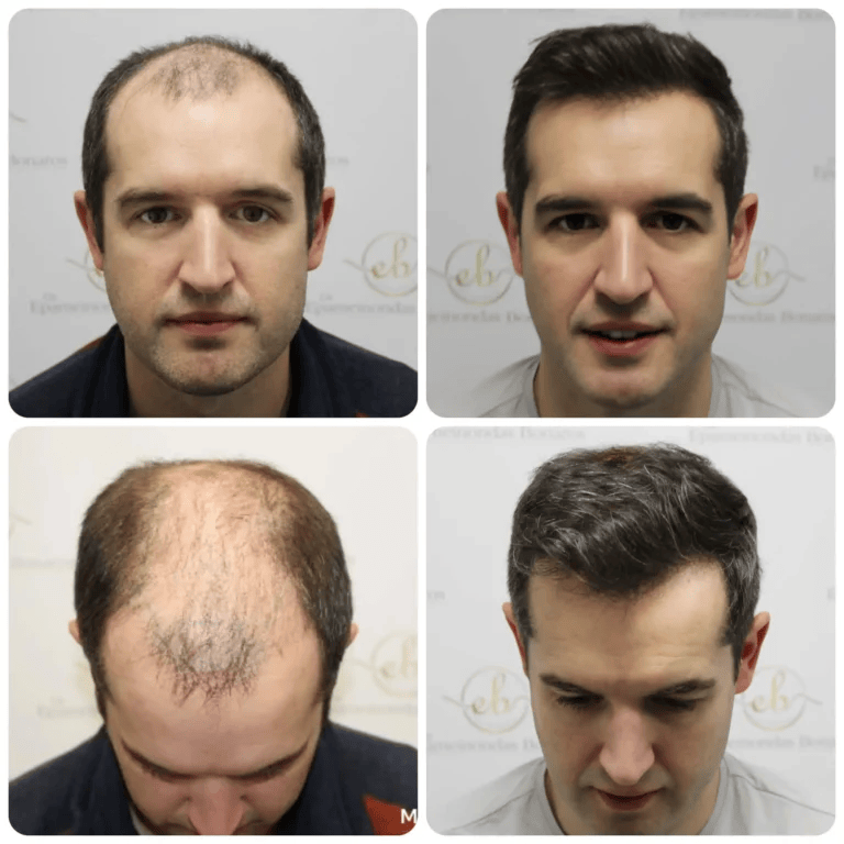 before and after