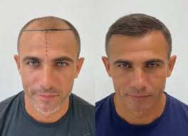أفضل طبيب زراعة شعر