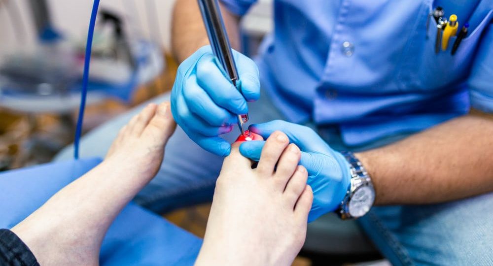 Onychomycosis