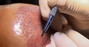 hair restoration in Lebanon
