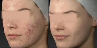 vascular laser