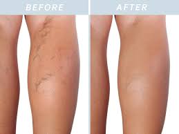 vascular laser