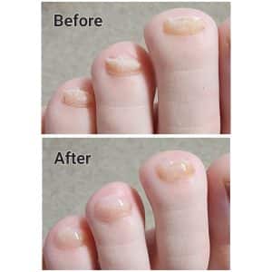 Nail restoration