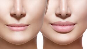 lip fillers فيلر الشفايف