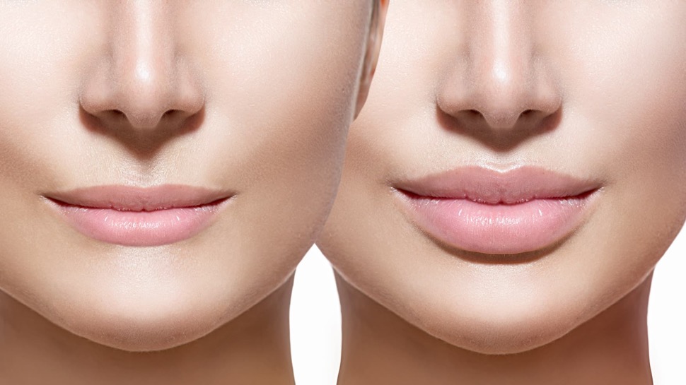 lip fillers