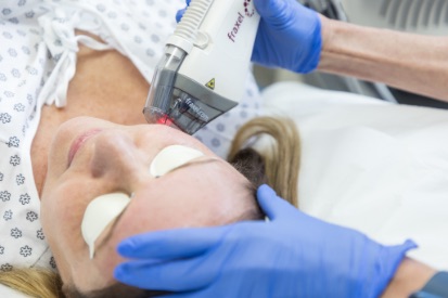 Fraxel Laser Treatment