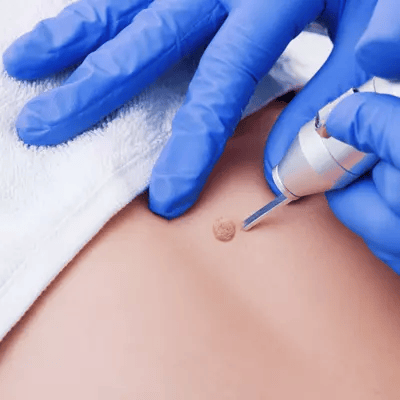 NdYAG Laser Treatment