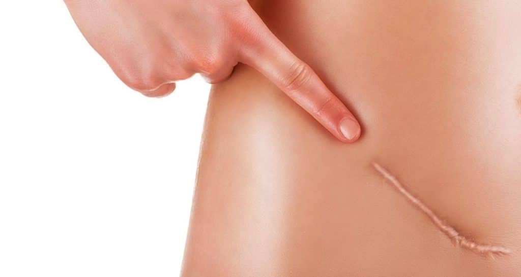 Laser Scar Removal